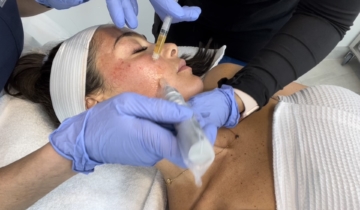 The Vampire Facial (PRP) Everything You Need to Know