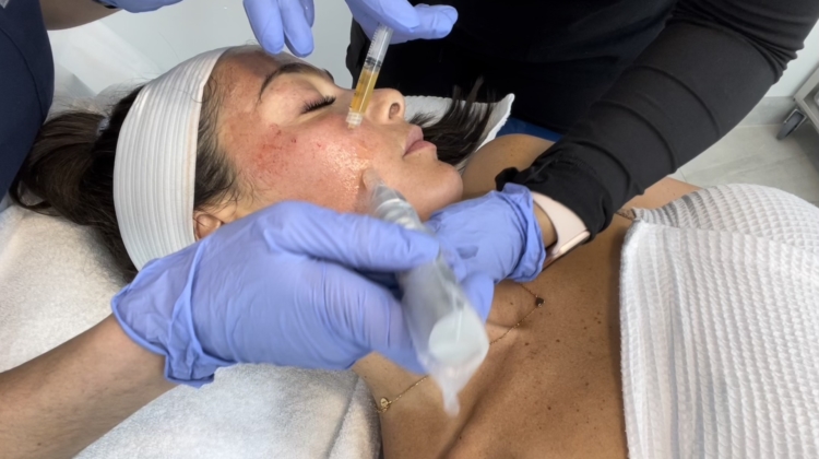 The Vampire Facial (PRP) Everything You Need to Know