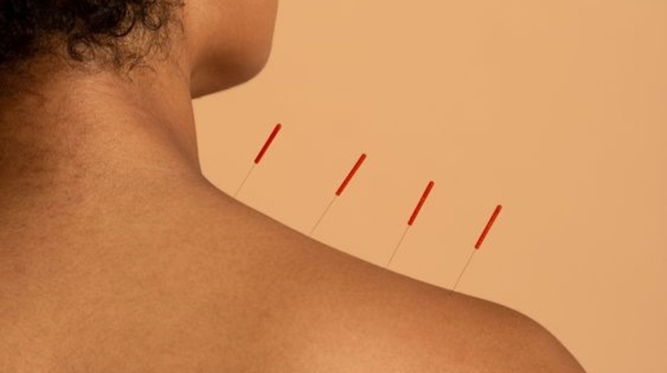 Acupuncture: The basics. Everything you need to know.