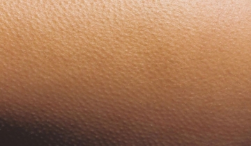 Goodbye Chicken Skin: Managing Keratosis Pilaris the Right Way
