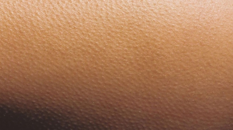 Goodbye Chicken Skin: Managing Keratosis Pilaris the Right Way